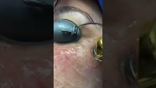 Dermatologist Removes Sun Spots #laser