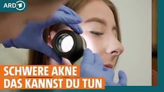 Akne – Was hilft bei Pickeln Pusteln und Mitessern? I ARD Gesund  Re-Upload