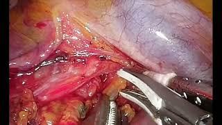 Asvide Lymph node dissection in the right upper mediastinum.