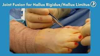 Fusion of Great Toe Joint for Hallux RigidusHallux Limitus