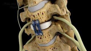 C4-5 Anterior Cervical Diskectomy with Fusion