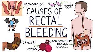 Understanding the Causes of Blood in Stool Rectal Bleeding