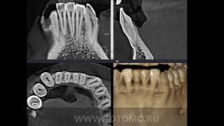 Компьютерная томография нижней челюсти - 3dtomo.ru