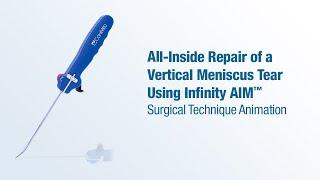 All-Inside Repair of Vertical Meniscus Tear Using Infinity AIM™ - CONMED Animation