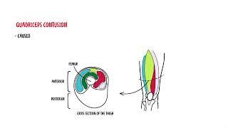 Quadriceps Muscle - quadriceps mujscle injury strain quadriceps contusion