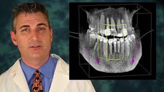 What is a dental implant sinus lift bone graft?