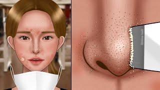 ASMR Satisfying Nose Sebum Removal Animation‼️Blackheads and Sebaceous Cysts Inside the Mask acne