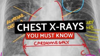 10 MUST KNOW Chest X-Rays For MedicalPA Finals  CXRs Made Easy