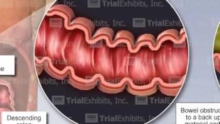 Bowel Perforation