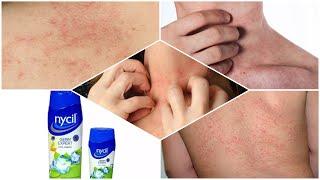 Nycil germ expert prickly heat powder for body rashes  कब कैसे लगाये