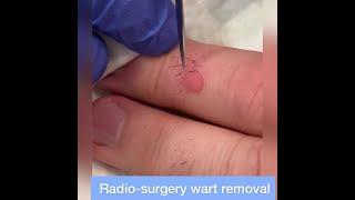 Wart Removal by Radiosurgery - Quick & Thorough Removal of Stubborn Finger Warts