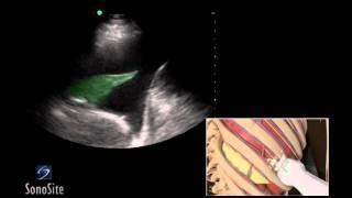 How To Ultrasound Guided Thoracentesis Exam 3D Video