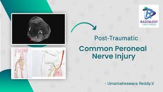 Common Peroneal Nerve Injury#Foot drop MRI  Umamaheswara Reddy.V