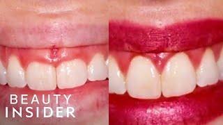 Gum Contouring Can Transform Your Smile