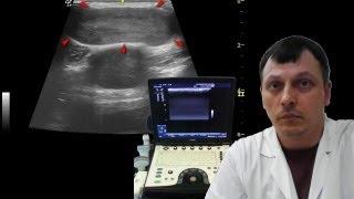 Pediatric Soft Tissue Ultrasound - Chest wall lesion