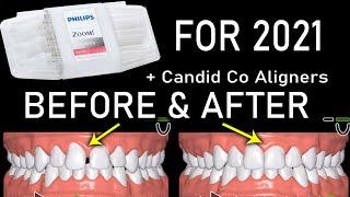 Candid Co BEFORE and AFTER Teeth Aligners Discount Code + Philips Zoom DayWhite