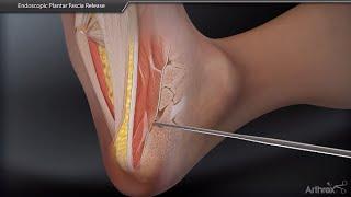 Endoscopic Plantar Fascia Release