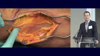 11  VIDEO  Proximal Tibia Fractures   David Shearer MD