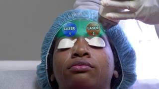 Brown and Black Skin Laser Treatment