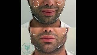 Angularization of the face #face #beauty #angelclinic #ascangela #angularzation #filler #botox