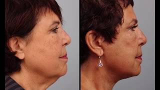 Day by Day Facelift & Necklift Recovery