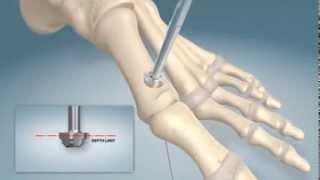 1st MTPJ arthrodesis procedure