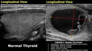 ACR TIRADS Classification Of Thyroid Nodules Ultrasound  Thyroid Imaging Reporting and Data System