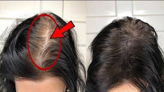 How To Increase Volume And Density Of Hair  Dr. Vivek Joshi