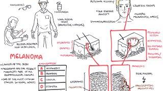 Melanoma - Overview signs and symptoms pathology risk factors treatment