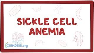 Sickle cell anemia - causes symptoms diagnosis treatment & pathology