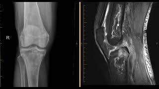 Avascular necrosis AVN osteonecrosis of knee