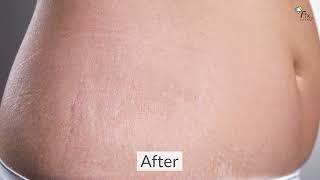 Stretch Mark Removal Cream Fixderma- Strallium Stretch Marks Cream