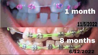 1st - 8th months Braces journey overbite & Gaps closing updates