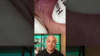 Doctor reacts to super satisfying pimple pops #dermreacts #doctorreacts #pimplepop #cystpop