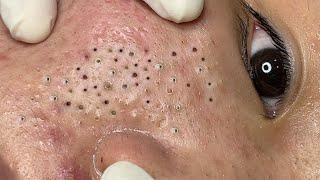 Treatment Blackheads and Acne Hidden Under The Eyes