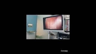 جراحی فتق در یک خانم به روش لاپاراسکوپی Female laparoscopic inguinal hernia  repair part1