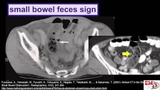 CT Imaging  Small Bowel Obstruction SBO