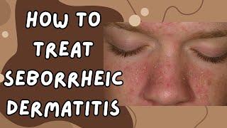 SEBORRHEIC DERMATITIS TREATMENT Get Rid of DANDRUFF NOW