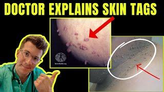 Doctor explains SKIN TAGS - including CLINICAL PHOTOS CAUSES & TREATMENT