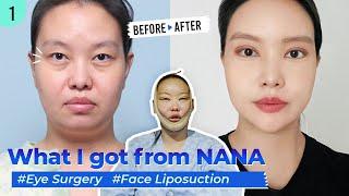 SUB Mom of twos journey at Nana Hospital  Face Liposuction Incisional Double Eyelid and more