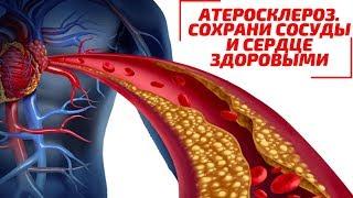 Атеросклероз. Причины  и последствия.