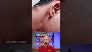 Massive Abscess Pop #pimplepop #dermreacts #doctorreacts