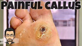 CALLUS REMOVAL FROM FEET