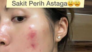 Derita Acne Prone Sensitive Skin