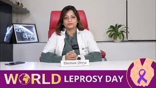 World Leprosy Day -Dietitian Shreya