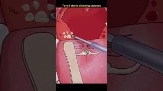 Tonsil stone cleaning