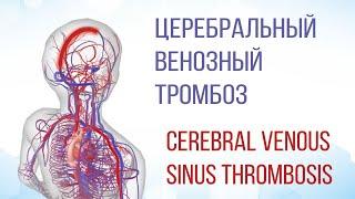 Церебральный венозный тромбоз  Cerebral Venous Sinus Thrombosis