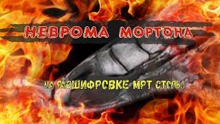 НЕВРОМА МОРТОНА с симптомами ТРАБЕКУЛЯРНОГО ОТЕКА 1 плюсневой кости на РАСШИФРОВКЕ МРТ стопы