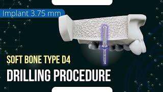 Drilling procedure for XGate Dental X11 and X3 Pure&Porous Implant 3.75 mm diameter bone type D4