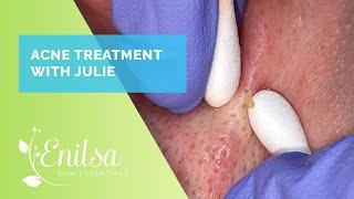 Acne Treatment & Extractions on Julie - New Patient